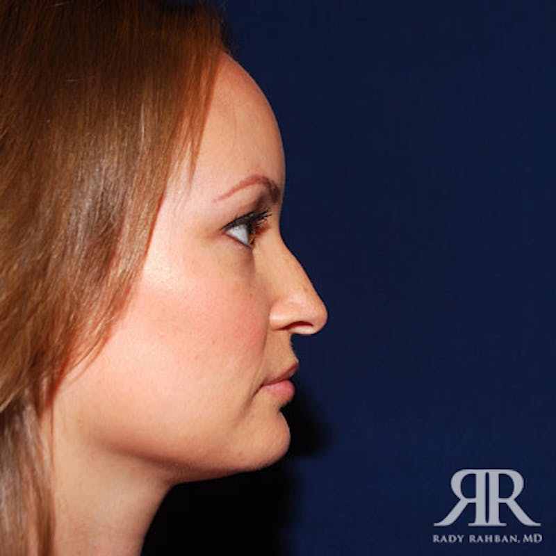 Female Rhinoplasty Before & After Gallery - Patient 116343 - Image 3