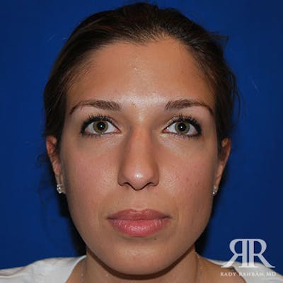 Ethnic Rhinoplasty Before & After Gallery - Patient 401148 - Image 1