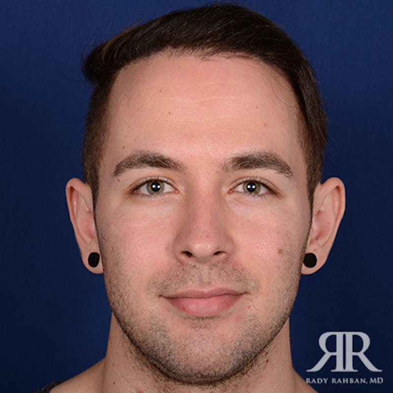 Ear Pinning Surgery Before & After Gallery - Patient 591540 - Image 1