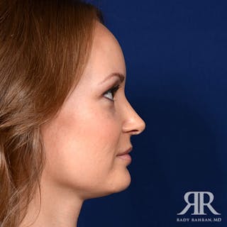 Female Rhinoplasty Before & After Gallery - Patient 116343 - Image 4