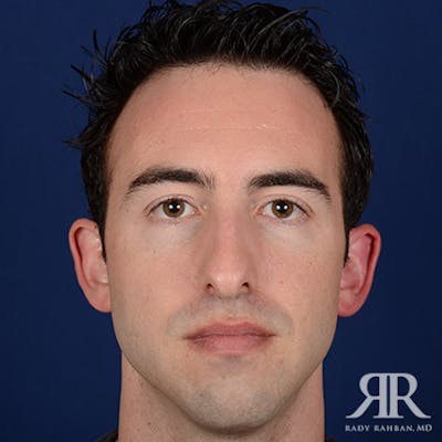 Male Rhinoplasty Before & After Gallery - Patient 806898 - Image 1