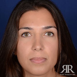 Ethnic Rhinoplasty Before & After Gallery - Patient 401148 - Image 2