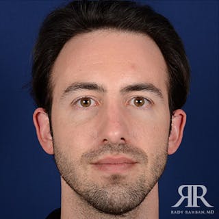 Male Rhinoplasty Before & After Gallery - Patient 806898 - Image 2