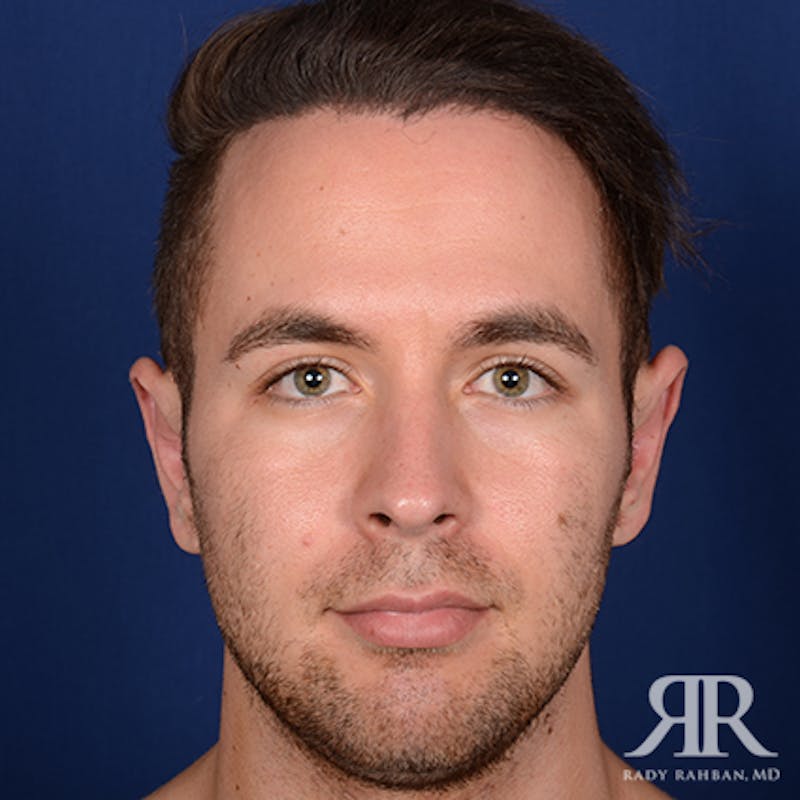 Before and after patient results