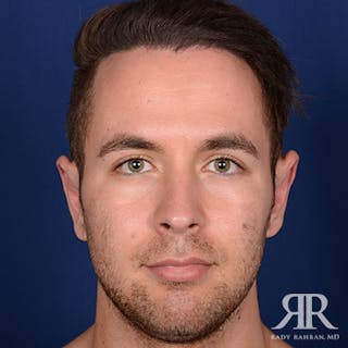 Ear Pinning Surgery Before & After Gallery - Patient 591540 - Image 2