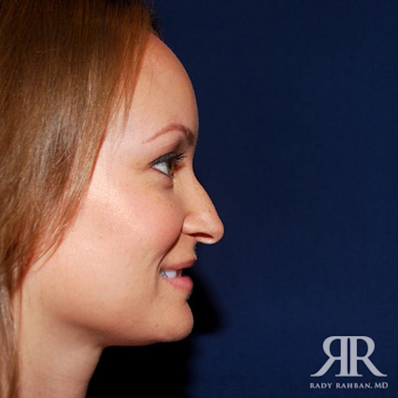 Female Rhinoplasty Before & After Gallery - Patient 116343 - Image 5