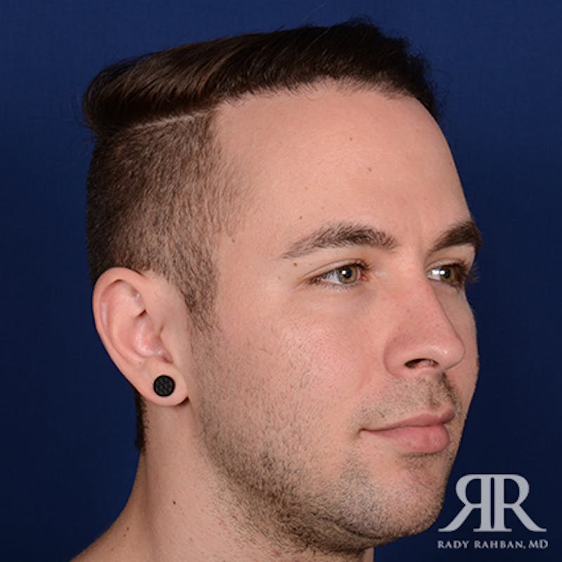 Ear Pinning Surgery Before & After Gallery - Patient 591540 - Image 3