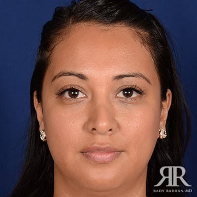 Corrective / Revision Rhinoplasty Before & After Gallery - Patient 347571 - Image 1