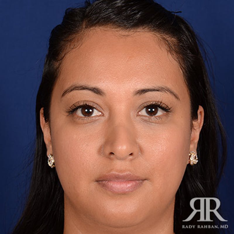 Corrective / Revision Rhinoplasty Before & After Gallery - Patient 347571 - Image 1