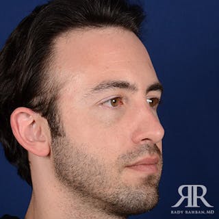 Male Rhinoplasty Before & After Gallery - Patient 806898 - Image 4