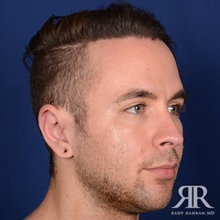 Ear Pinning Surgery Before & After Gallery - Patient 591540 - Image 4