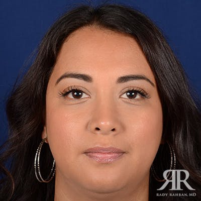 Corrective / Revision Rhinoplasty Before & After Gallery - Patient 347571 - Image 2