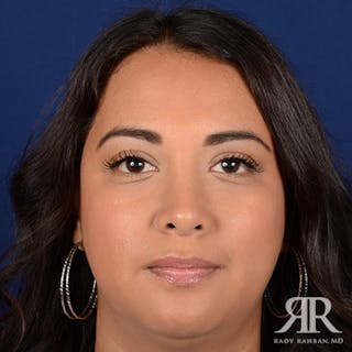 Corrective / Revision Rhinoplasty Before & After Gallery - Patient 347571 - Image 2