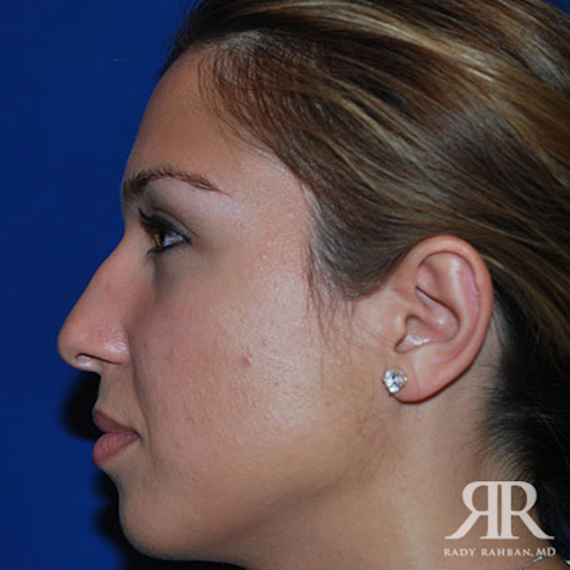 Ethnic Rhinoplasty Before & After Gallery - Patient 401148 - Image 5