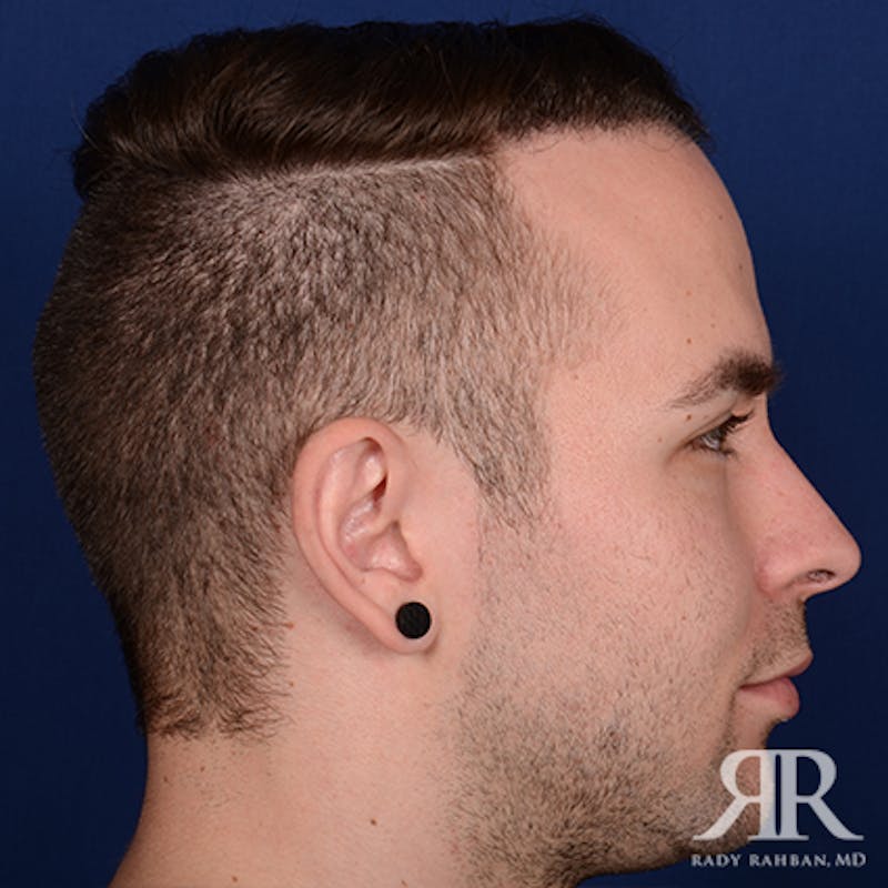 Ear Pinning Surgery Before & After Gallery - Patient 591540 - Image 5