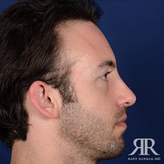 Male Rhinoplasty Before & After Gallery - Patient 806898 - Image 6