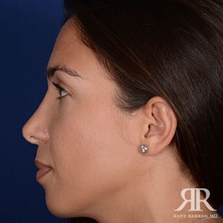 Ethnic Rhinoplasty Before & After Gallery - Patient 401148 - Image 6