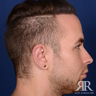 Ear Pinning Surgery Before & After Gallery - Patient 591540 - Image 6