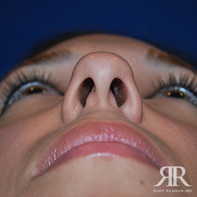 Ethnic Rhinoplasty Before & After Gallery - Patient 401148 - Image 7