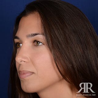 Female Rhinoplasty Before & After Gallery - Patient 273317 - Image 4