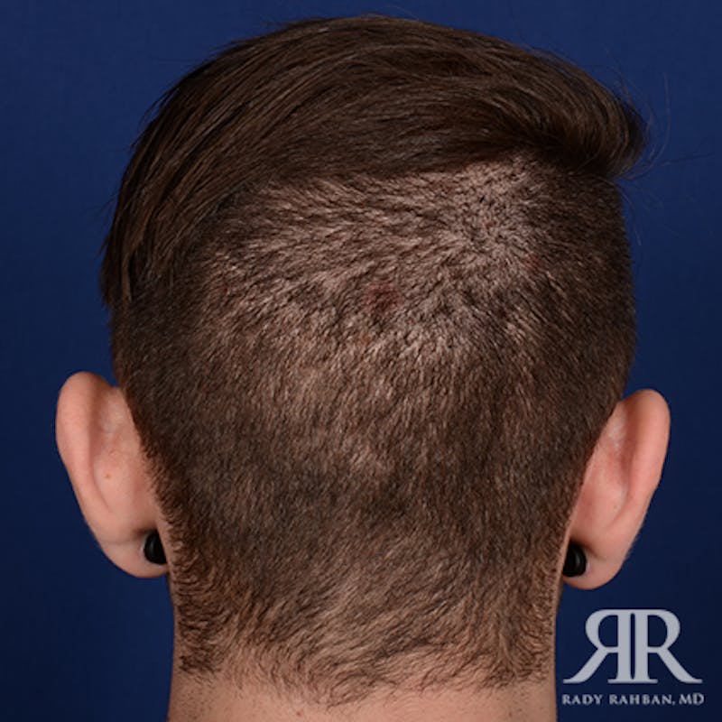 Ear Pinning Surgery Before & After Gallery - Patient 591540 - Image 7