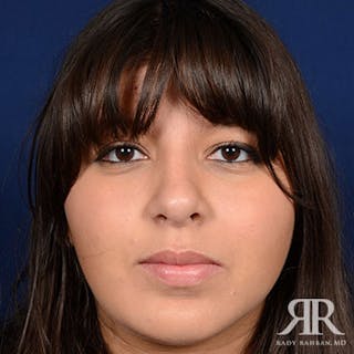 Rhinoplasty w/ Chin Implant Before & After Gallery - Patient 265941 - Image 2