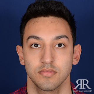 Male Rhinoplasty Before & After Gallery - Patient 352421 - Image 2