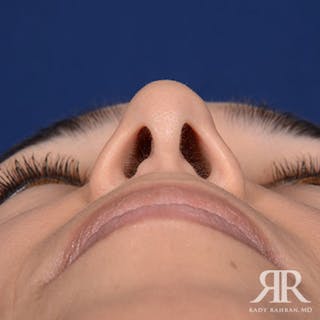 Ethnic Rhinoplasty Before & After Gallery - Patient 401148 - Image 8