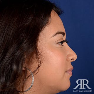 Corrective / Revision Rhinoplasty Before & After Gallery - Patient 347571 - Image 6