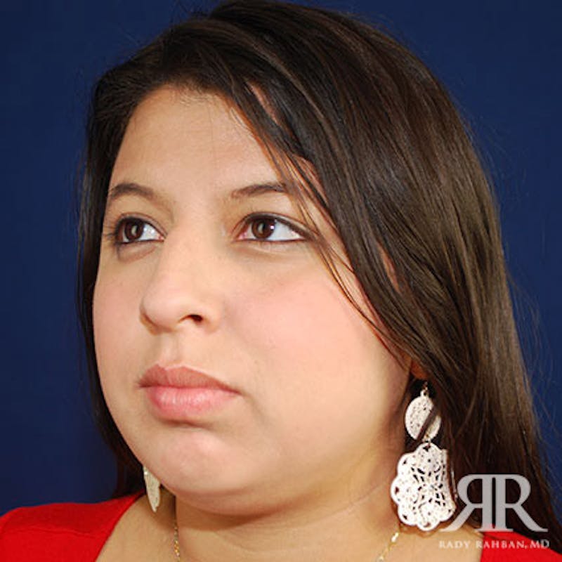 Rhinoplasty w/ Chin Implant Before & After Gallery - Patient 265941 - Image 3