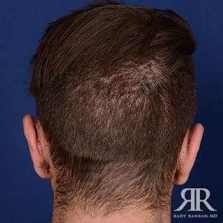Ear Pinning Surgery Before & After Gallery - Patient 591540 - Image 8