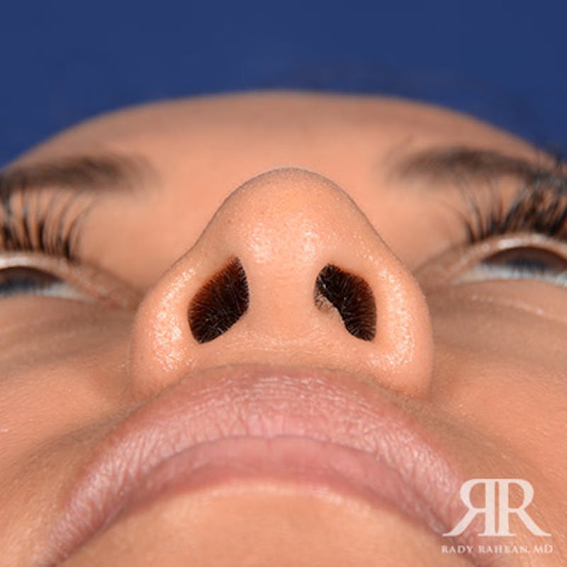 Corrective / Revision Rhinoplasty Before & After Gallery - Patient 347571 - Image 7