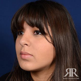 Rhinoplasty w/ Chin Implant Before & After Gallery - Patient 265941 - Image 4