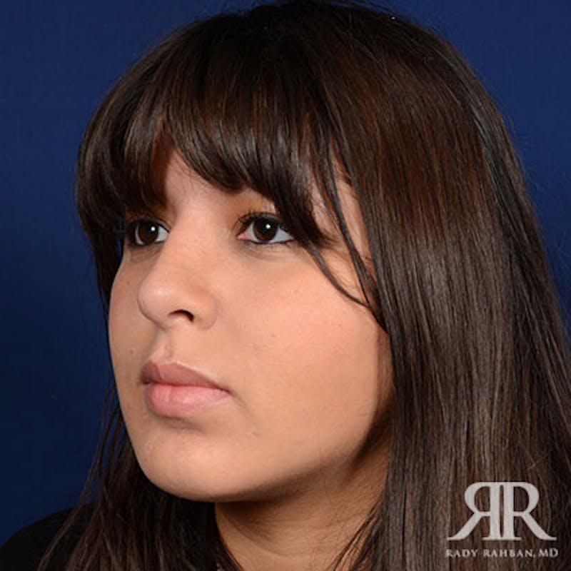 Rhinoplasty w/ Chin Implant Before & After Gallery - Patient 265941 - Image 4