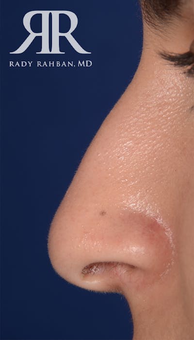 Rhinoplasty Close Up Before & After Gallery - Patient 262638 - Image 1