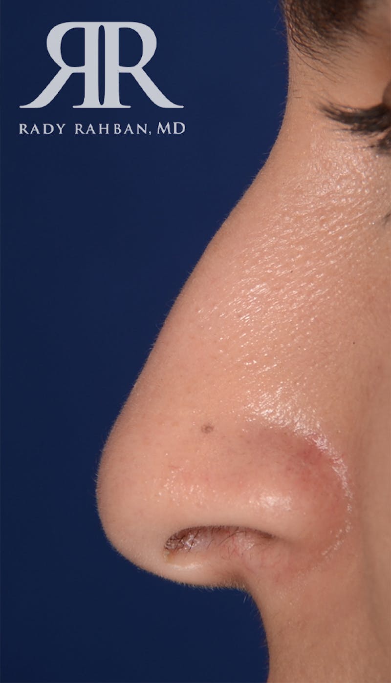 Rhinoplasty Close Up Before & After Gallery - Patient 262638 - Image 1
