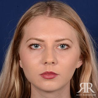 Chin Augmentation Before & After Gallery - Patient 118071 - Image 2
