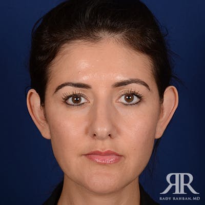 Ear Pinning Surgery Before & After Gallery - Patient 233319 - Image 1