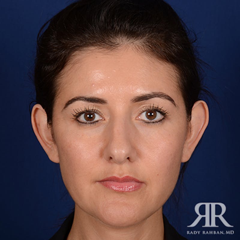Ear Pinning Surgery Before & After Gallery - Patient 233319 - Image 1