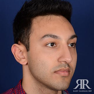Male Rhinoplasty Before & After Gallery - Patient 352421 - Image 4