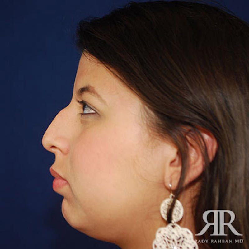 Rhinoplasty w/ Chin Implant Before & After Gallery - Patient 265941 - Image 5