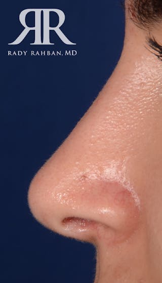 Rhinoplasty Close Up Before & After Gallery - Patient 262638 - Image 2