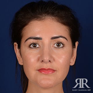 Ear Pinning Surgery Before & After Gallery - Patient 233319 - Image 2