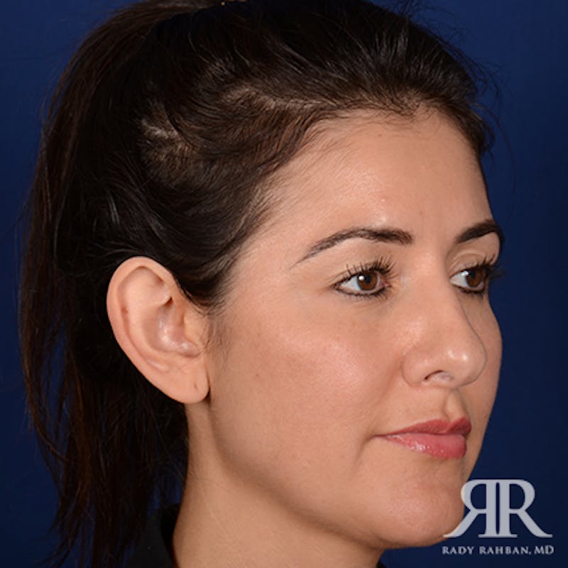 Ear Pinning Surgery Before & After Gallery - Patient 233319 - Image 3