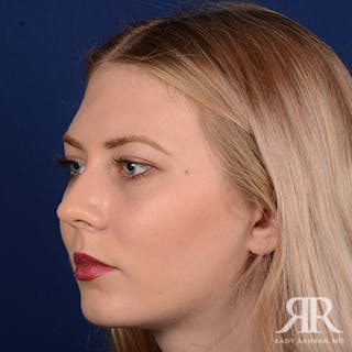 Chin Augmentation Before & After Gallery - Patient 118071 - Image 4