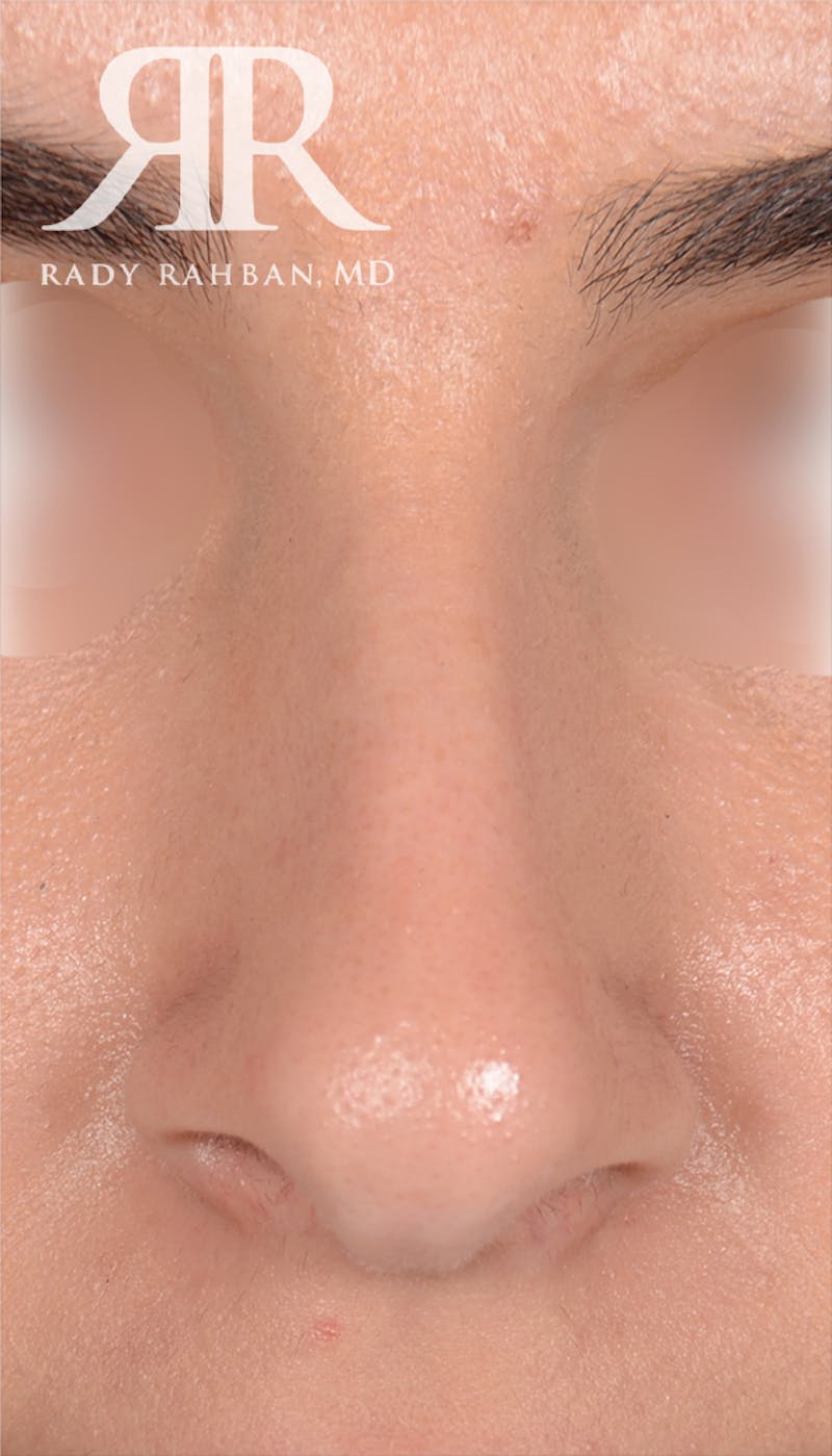 Rhinoplasty Close Up Before & After Gallery - Patient 262638 - Image 3