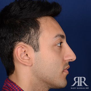 Male Rhinoplasty Before & After Gallery - Patient 352421 - Image 6