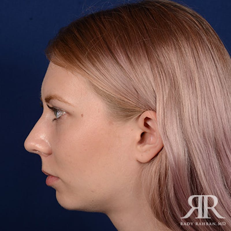 Chin Augmentation Before & After Gallery - Patient 118071 - Image 5