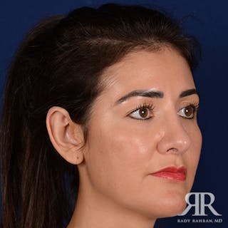 Ear Pinning Surgery Before & After Gallery - Patient 233319 - Image 4