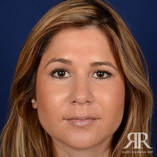 Female Rhinoplasty Before & After Gallery - Patient 225866 - Image 2